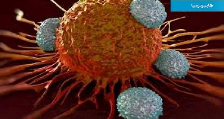 بررسی و حل مسائل کنترل بهینه گرمای زیستی در هایپرترمیا یا نابود کردن سلول های سرطانی